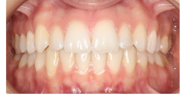 Patient's smile after orthodontic treatment at Maui Orthodontics