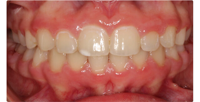 Patient's smile after orthodontic treatment at Maui Orthodontics.