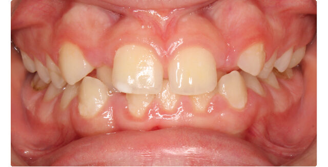 Before orthodontic treatment showcasing misaligned teeth and smile imperfections.