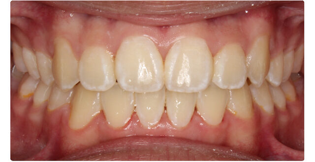 Patient's smile after orthodontic treatment at Maui Orthodontics