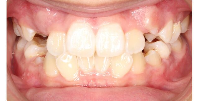 Before orthodontic treatment: patient's smile with misaligned teeth