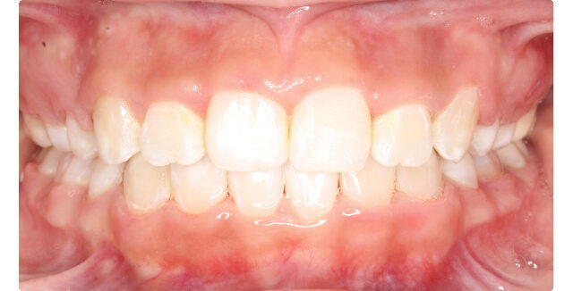 Patient's smile after orthodontic treatment at Maui Orthodontics