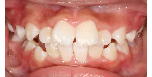 Before orthodontic treatment: patient's teeth with misalignment and gaps.
