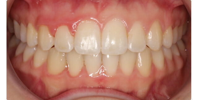 Patient's smile before orthodontic treatment at Maui Orthodontics