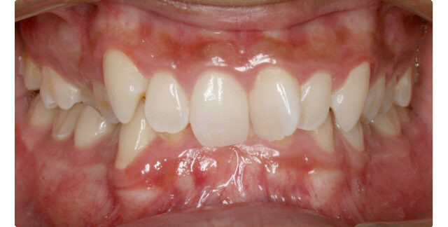 Patient's teeth before orthodontic treatment at Maui Orthodontics.