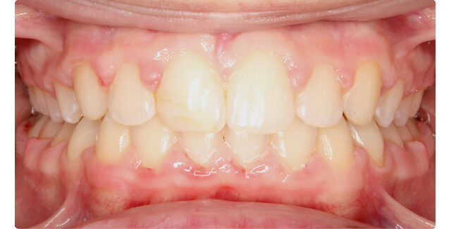 Patient's smile after orthodontic treatment at Maui Orthodontics.