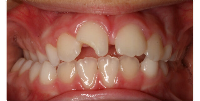 Before orthodontic treatment: patient's teeth showing misalignment at Maui Orthodontics