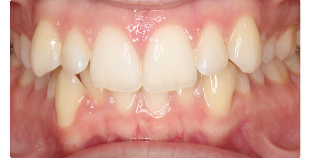 Before orthodontic treatment: patient's teeth with misalignment at Maui Orthodontics.