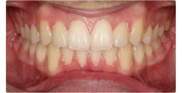 Patient's smile after orthodontic treatment at Maui Orthodontics.