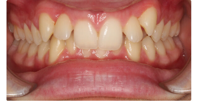 Before orthodontic treatment: patient's teeth at Maui Orthodontics