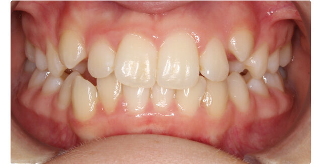 Before orthodontic treatment showcasing misaligned teeth and gaps.