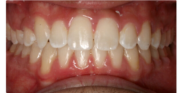 Patient's smile transformation after orthodontic treatment at Maui Orthodontics