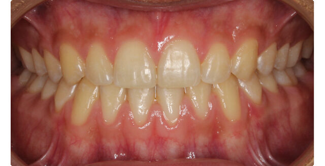Patient's teeth before orthodontic treatment at Maui Orthodontics.