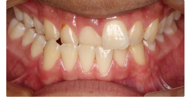 Patient's teeth before orthodontic treatment at Maui Orthodontics