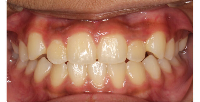 Patient's smile before orthodontic treatment at Maui Orthodontics