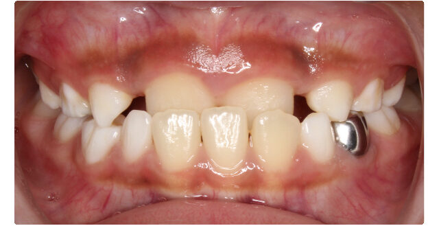 Before orthodontic treatment: patient's smile with teeth misalignment and a metal band.